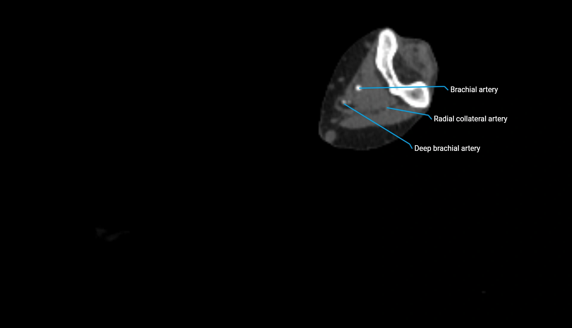 CTA upper limb axial cross sectional anatomy labelled image 196 (2).webp